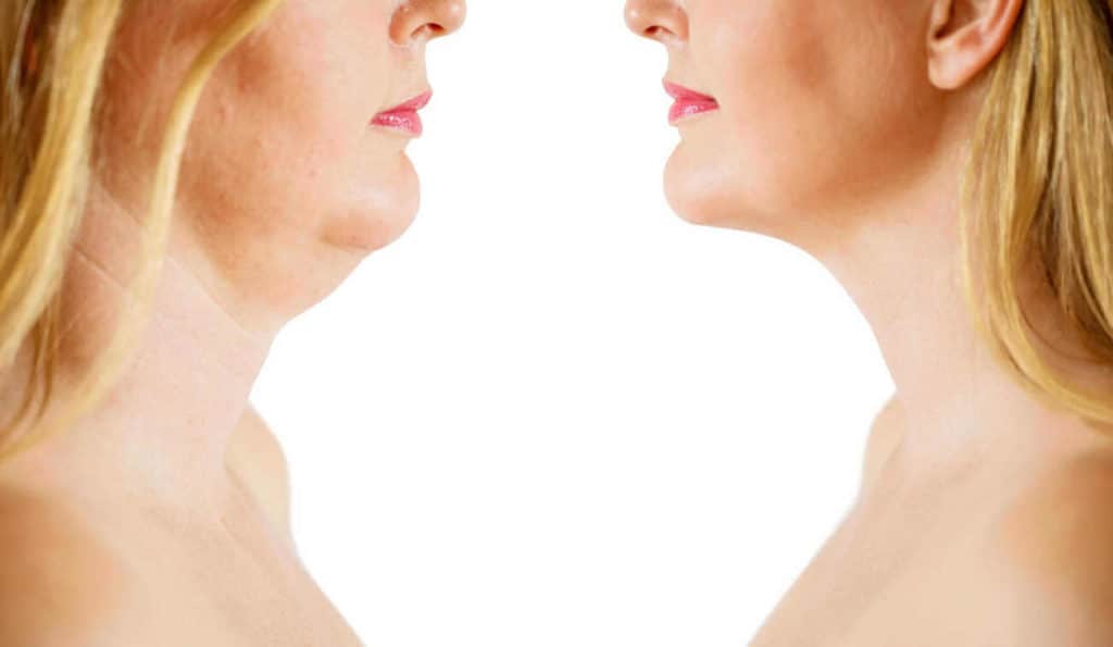 Double Chin treatment Enfield Town before and after results