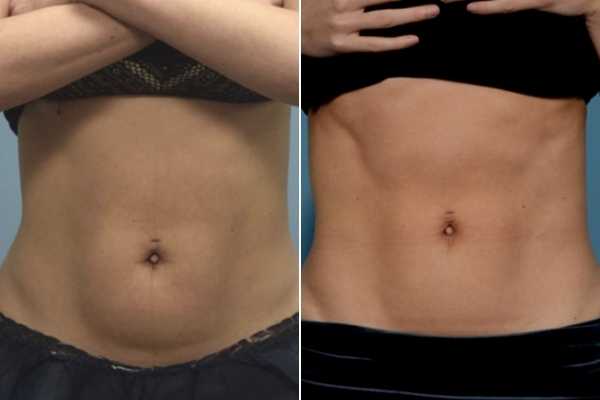 body sculpting FAQs Enfield Town