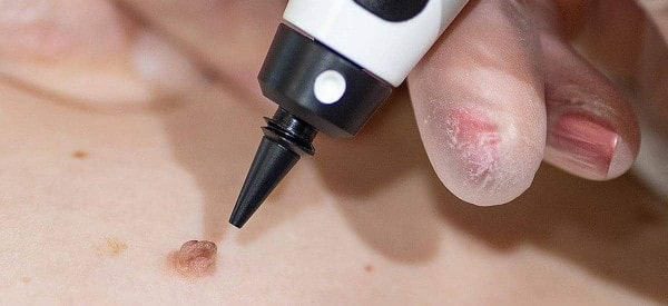 After Skin Tag Removal Enfield Town