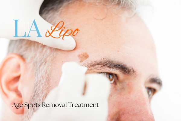 What Are the Most Effective Treatments for Age Spots Enfield Town?