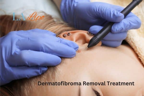 Dermatofibroma Removal Treatment Enfield Town