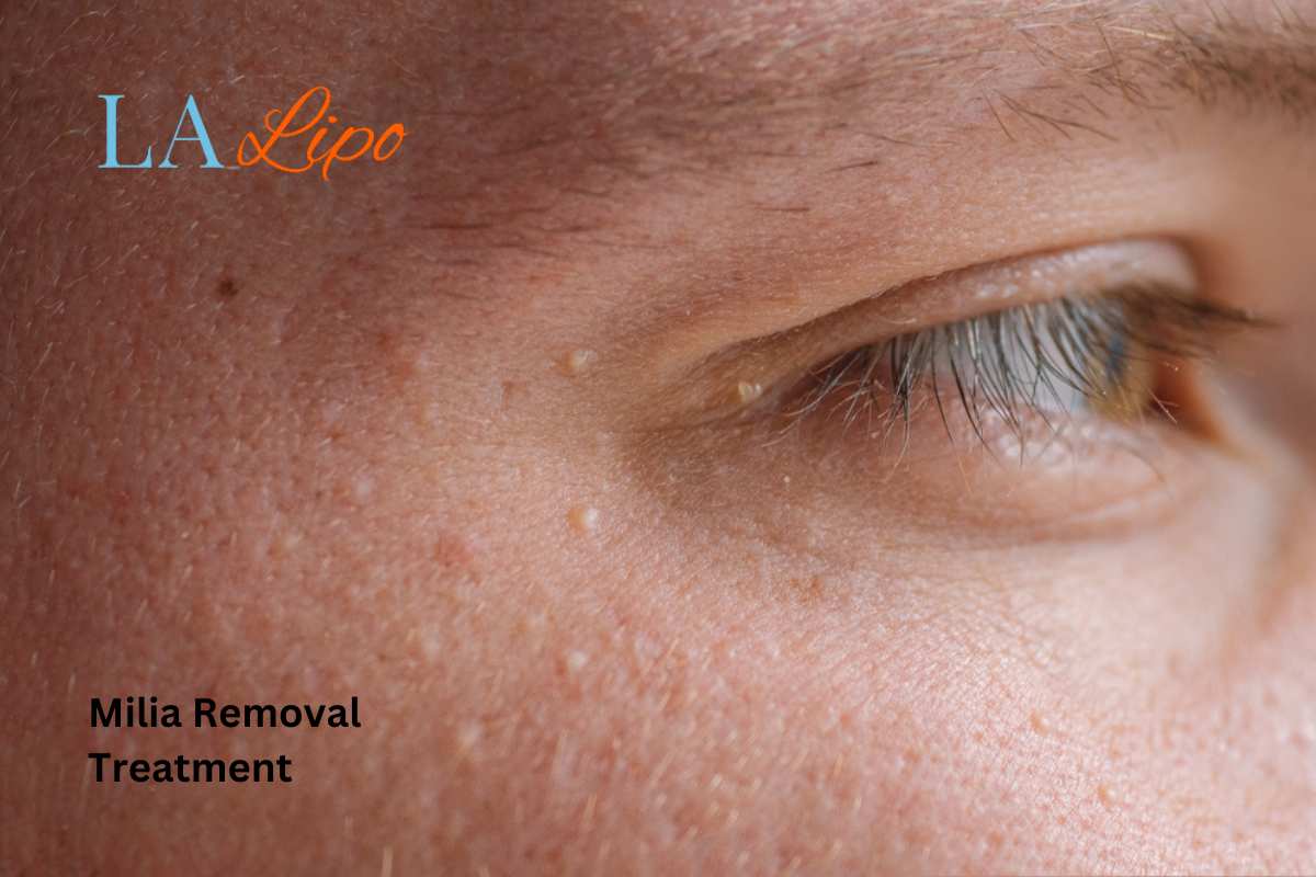 Cryopen Milia Removal: Is It the Easiest and Safest Option Enfield Town?