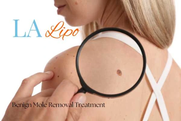 Why getting moles removed Enfield Town can boost your confidence!