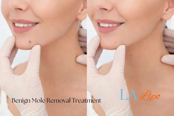 woman's before and after mole removal Enfield Town results