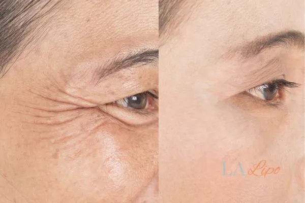 Before and after results of woman - HI-fu wrinkles reduction treatment Enfield Town