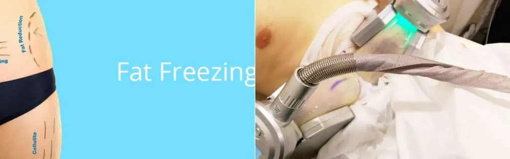 Fat freezing Enfield Town on multiple areas of the body