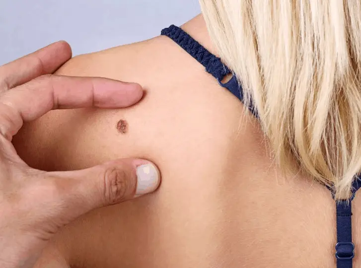 woman having mole removal Enfield Town consultation before treatment.