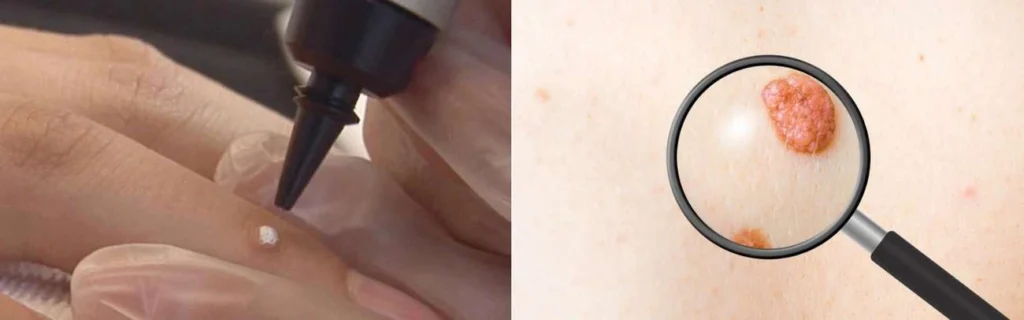 Person getting moles removed with cryopen Enfield Town