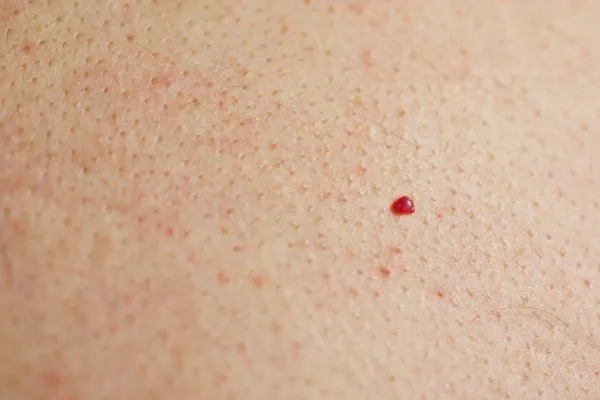 close up of a cherry angioma Enfield Town