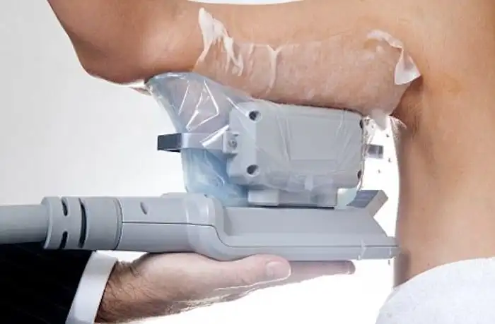 Picture of fat freezing Enfield Town on the upper arms.
