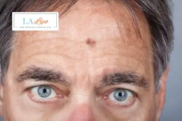 Solar Lentigo Removal Enfield Town image of man with mark on his forehead