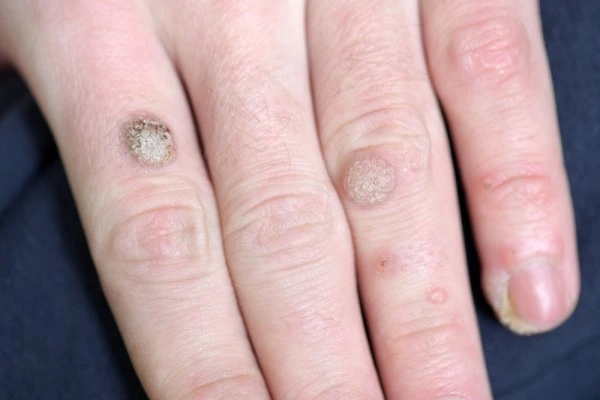 photo of warts on person hand - see wart removal Enfield Town from LA LIPO