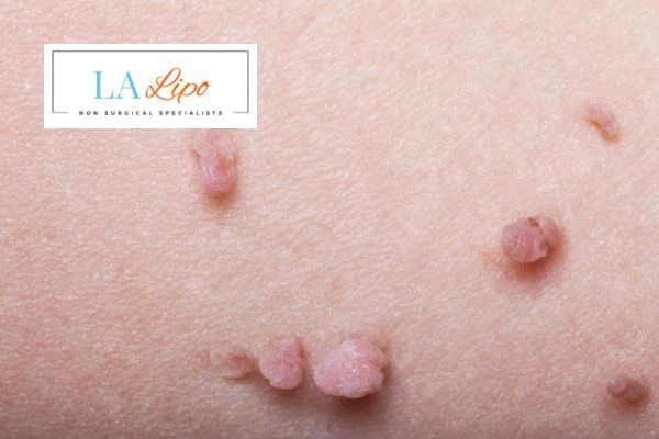 Does cryopen skin tag removal Enfield Town hurt? Find out now call our team today!