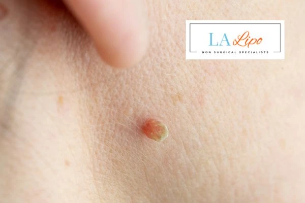 Book skin tag removal Enfield Town today speak to our team now!