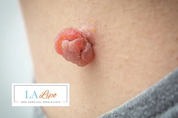Interested in skin tag removal Enfield Town? Concerned about the pain? Find out more today!