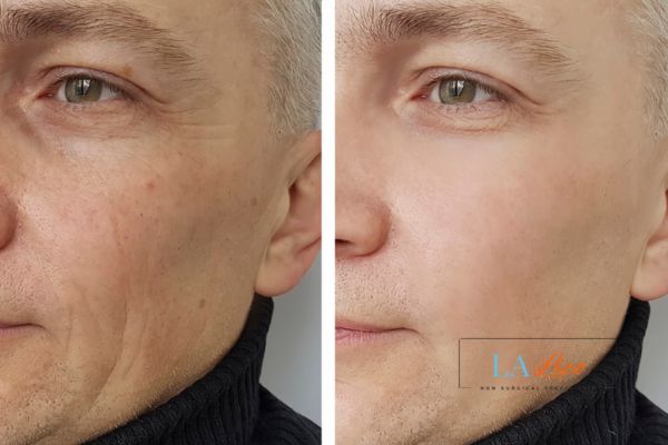 See the amazing results of Morpheus8 Treatment Enfield Town!