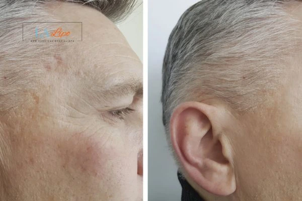 Mens Before & After Morpheus 8 Results Enfield Town