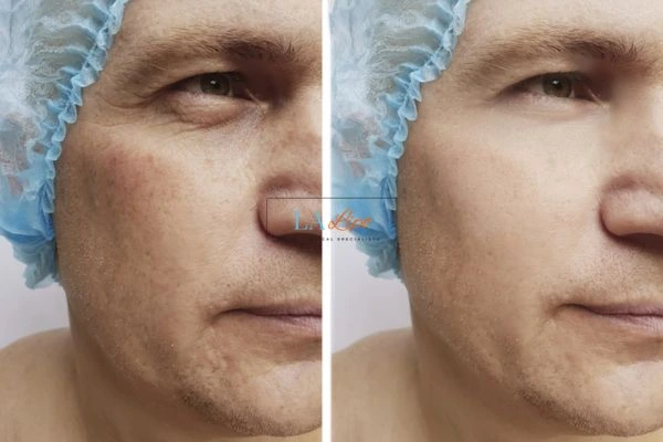 Before and after Morpheus 8 Results Enfield Town