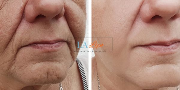 Older lady deeper wrinkle reduction - LA LIPO Morpheus 8 Results Enfield Town