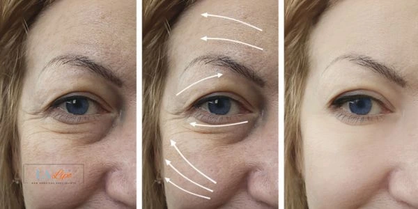 Amazing eye lift Morpheus 8 results Enfield Town