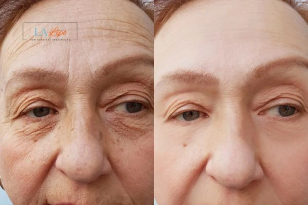 The powerful benefits of Morpheus8 Treatment Enfield Town - Call Our team today!