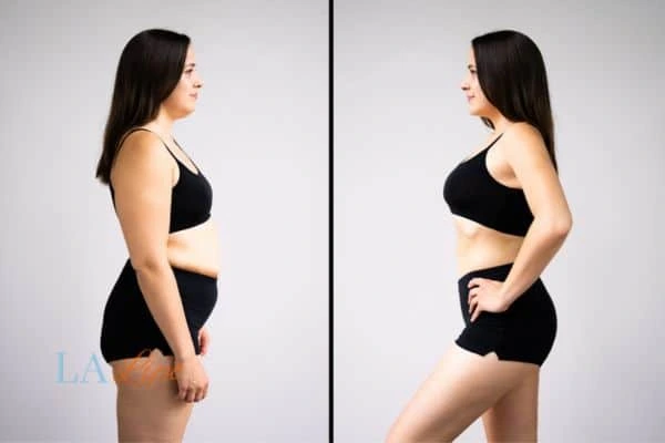 Picture of womans before and after using LA-EMS body sculpting to improve her core strength Enfield Town