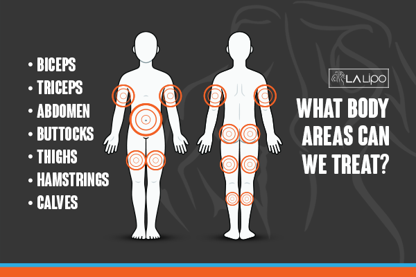 Diagram to show areas you can have LA-EMS Body Sculpting Treatment Enfield Town
