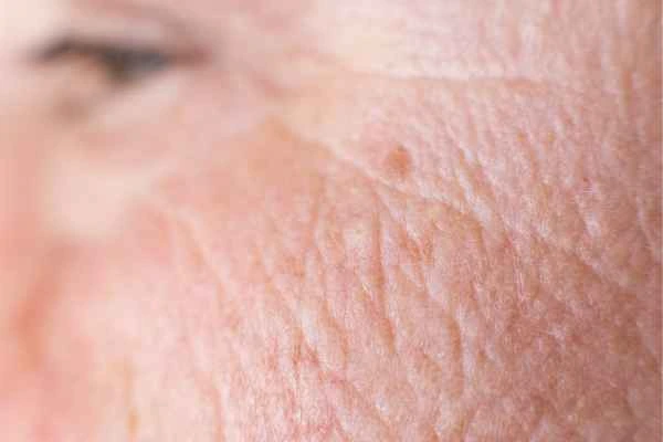 close up picture of a woman's face showing an age spot Enfield Town