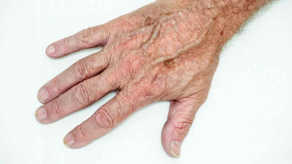 Male hand showing age spot Enfield Town