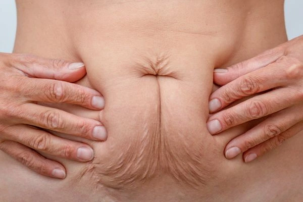 Image of a woman's stomach with loose skin - example of skin tightening Enfield Town options